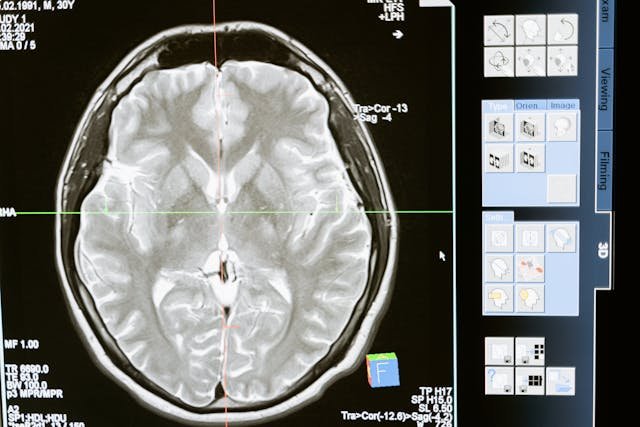 What You Can Do To Reduce Risks For Stroke